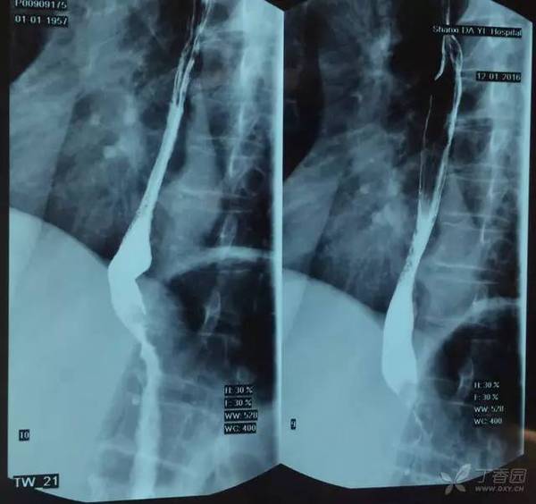 贲门癌转移肝癌4期是什么程度,得了贲门癌和肝癌能活多久