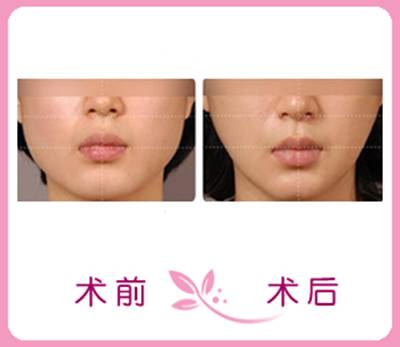 瘦脸针真的可怕吗,瘦脸针瘦腿针是什么原理