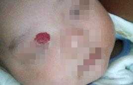 草莓状血管瘤打一次针多少钱,草莓状血管瘤治疗可以报销吗