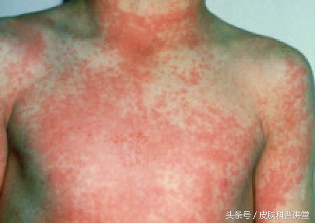 如何辨别儿童猩红热,儿童猩红热的症状与表现