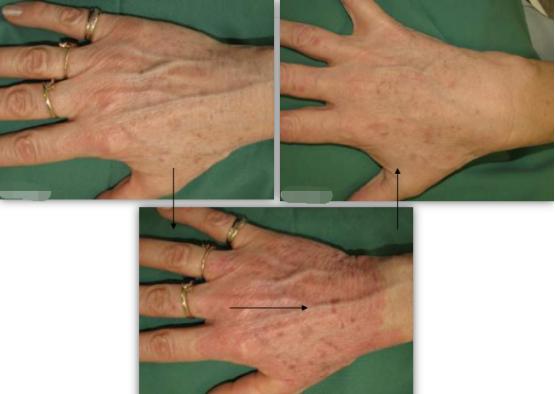 老年斑会导致雀斑吗,老年斑长大有危险吗