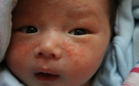 婴儿湿疹已经消了但又变得很红,宝宝湿疹好了以后皮肤会变黑