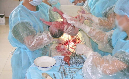 剖宫产原因分析报告,剖宫产到底是什么原因