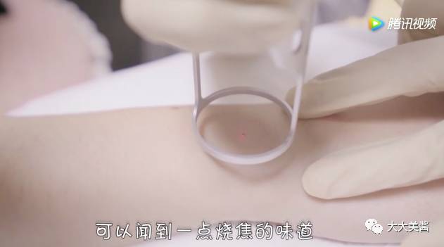 视频｜激光点痣，光洁皮肤不做小斑点汪汪