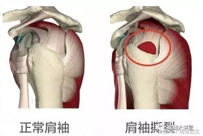 肩周炎积水潭专家,肩周炎医生讲解