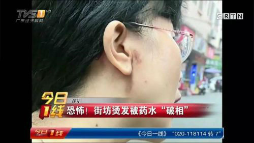 恐怖！深圳女子烫发直喊痛竟是药水腐蚀了皮肤