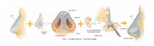 有谁做过达拉斯隆鼻,达拉斯隆鼻区别