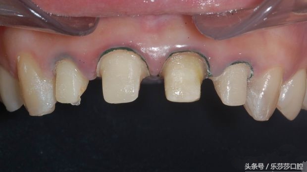 为什么牙医爱忽悠人做烤瓷牙,牙医的真相大全