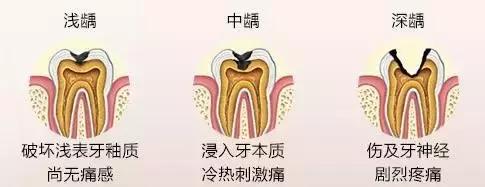 蛀牙了怎么防范再继续蛀牙下去,蛀牙居然是这样解决的