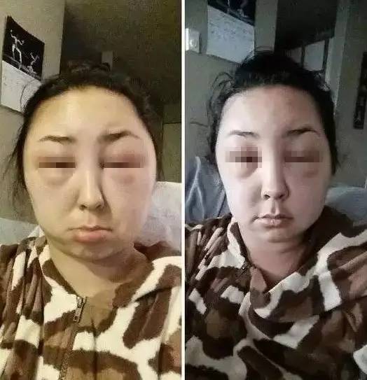 过敏的症状和治疗方法,各种过敏症状的处理方法