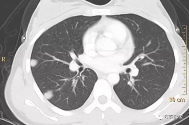 绒毛膜癌转移到脑,绒毛膜癌肺转移