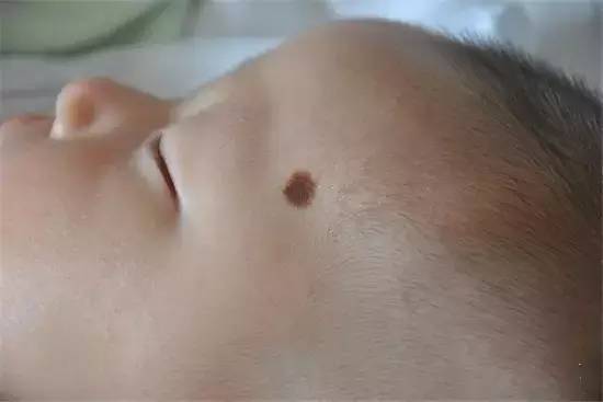 哪些胎记有危险,宝宝胎记是什么原因造成的