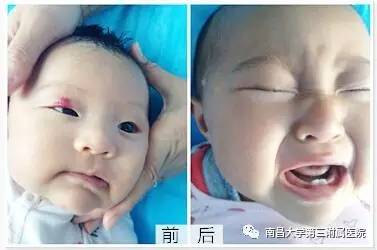 哪些胎记有危险,宝宝胎记是什么原因造成的