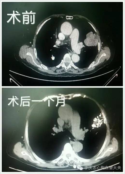 治疗肺癌的“核”*器武**——肺癌放射性粒子植入手术