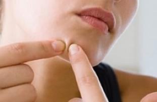 下巴长痘痘的原因和解决方法,内分泌失调下巴长痘痘吃什么药