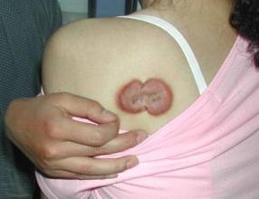 word妈呀!你真的不重视疤痕疙瘩治疗吗?看看这些危害吧