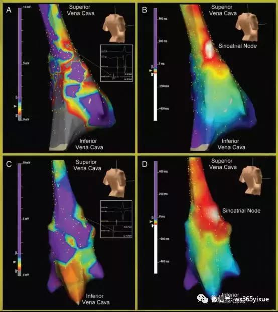 频发阵发性房颤需要怎么治疗好呢,房颤合并室速的治疗方案