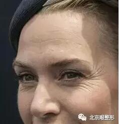 鱼尾纹，这样除最简单，一针即刻见效！