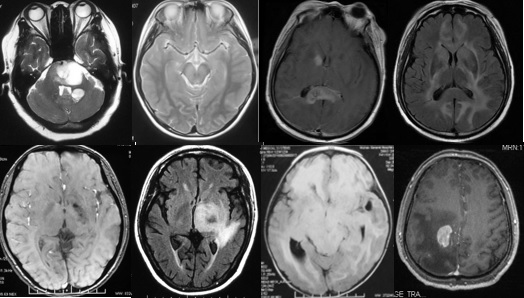 中枢神经脱髓鞘病是重大疾病吗,中枢神经系统脱髓鞘和多发性硬化
