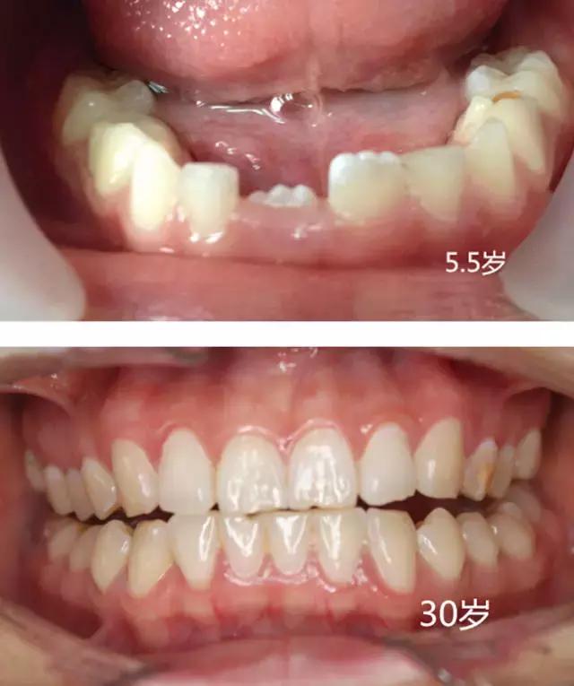 恒牙换牙不,恒牙不长出