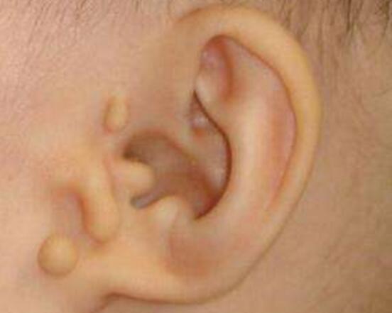 宝宝耳边有个小鼓包软软的,宝宝耳边长了个包