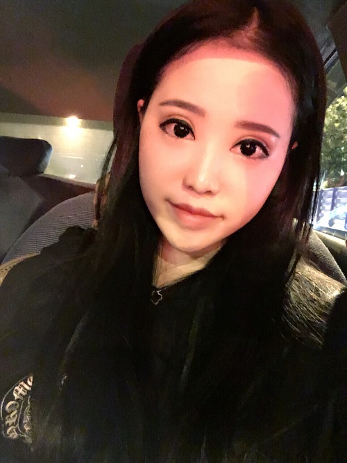 全切双眼皮疤痕增生多久可以恢复,全切双眼皮恢复过程经历真实