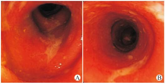 急性肠炎吃什么药效果快止泻,急性肠炎拉肚子如何快速止泻