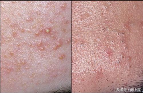 图解成年人常见的皮肤问题