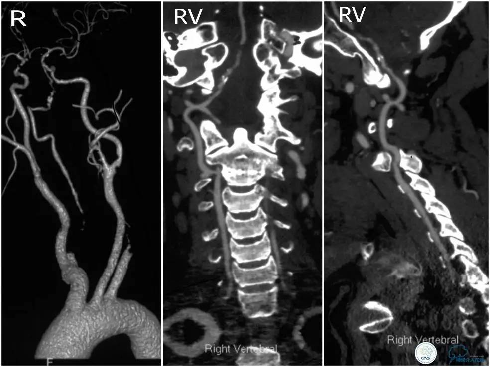 天坛周记|右椎动脉V1段及V4-基底动脉串联病变支架治疗一例