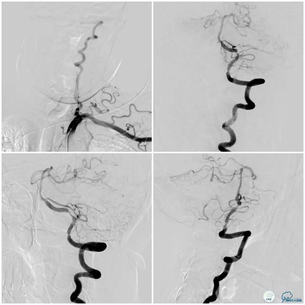 天坛椎动脉狭窄,天坛周记