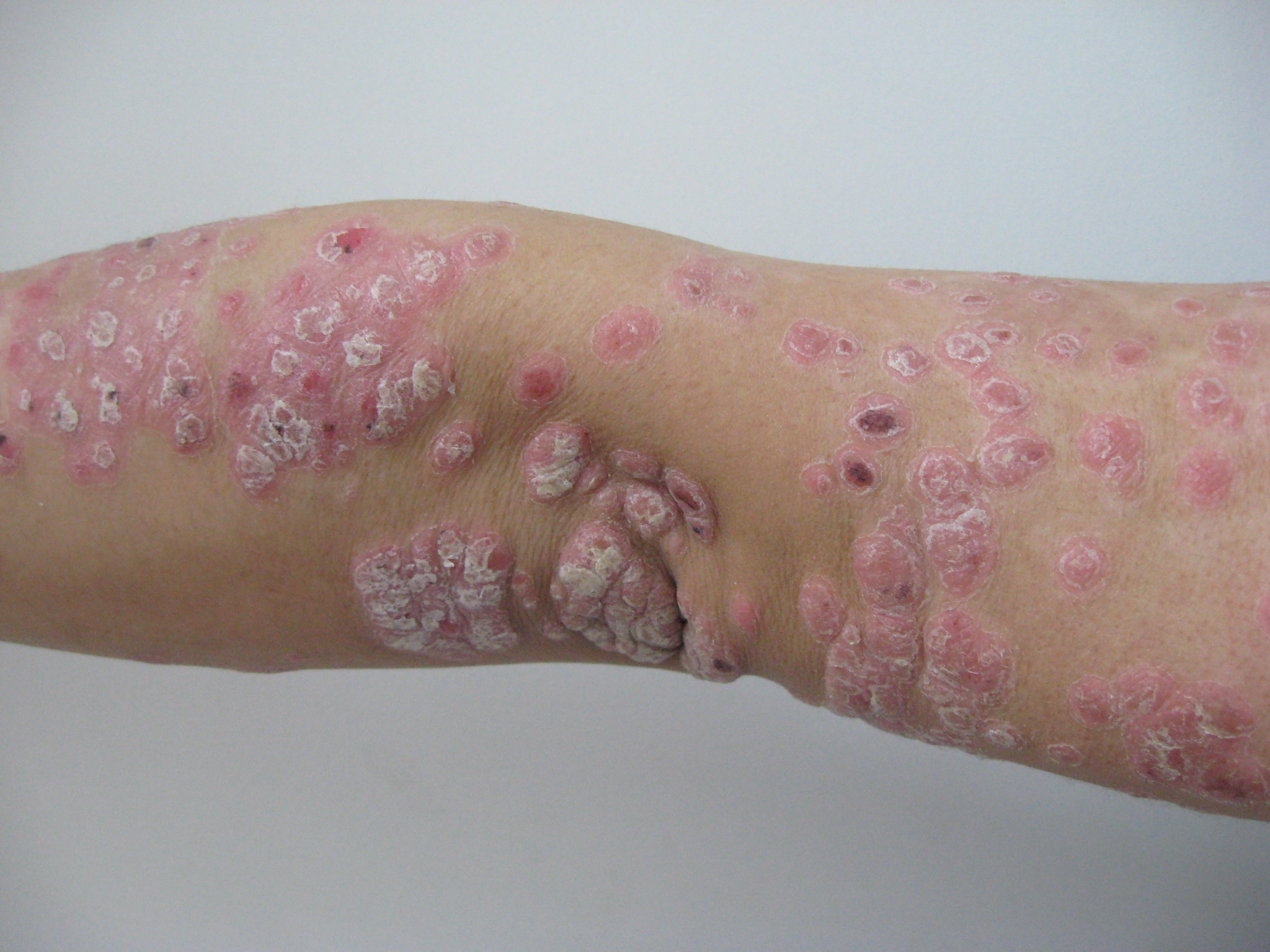 福州皮肤科看银屑病吗,武汉协和皮肤科银屑病