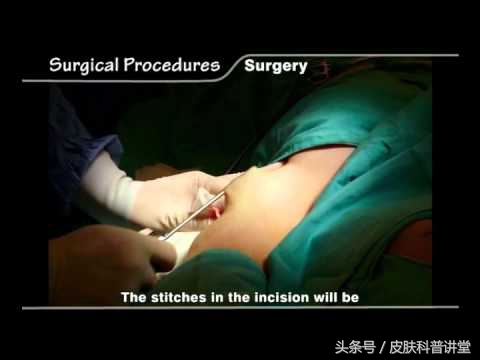 夏天腋臭怎么去除最快,祛除腋臭最彻底的治疗方法