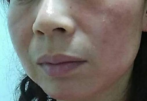 *血丝红**怎么治疗？教你7招祛除*血丝红**