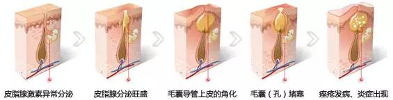 闭合性粉刺爆浆,闭合性粉刺还有痘印