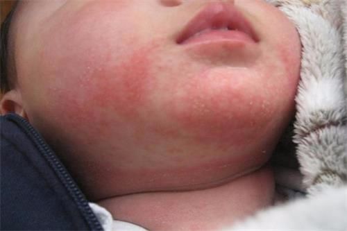 新生儿湿疹热疹宝妈要忌口吗,热痱子和湿疹荨麻疹有什么区别