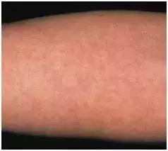 春风一吹身上起小疙瘩,春风吹的脸上起小疙瘩