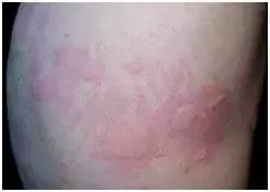 春风一吹身上起小疙瘩,春风吹的脸上起小疙瘩