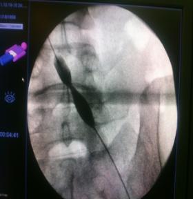 下肢肿胀有效的治疗手段是什么？