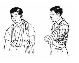 倒霉孩子骨折,倒霉透了手骨折