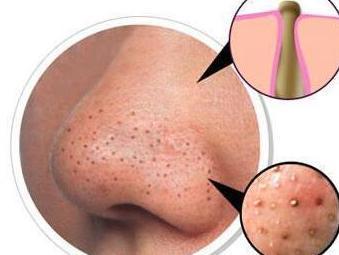 鼻子上的黑头粉刺挤出来有臭味,脸上的黑头粉刺该不该挤出来