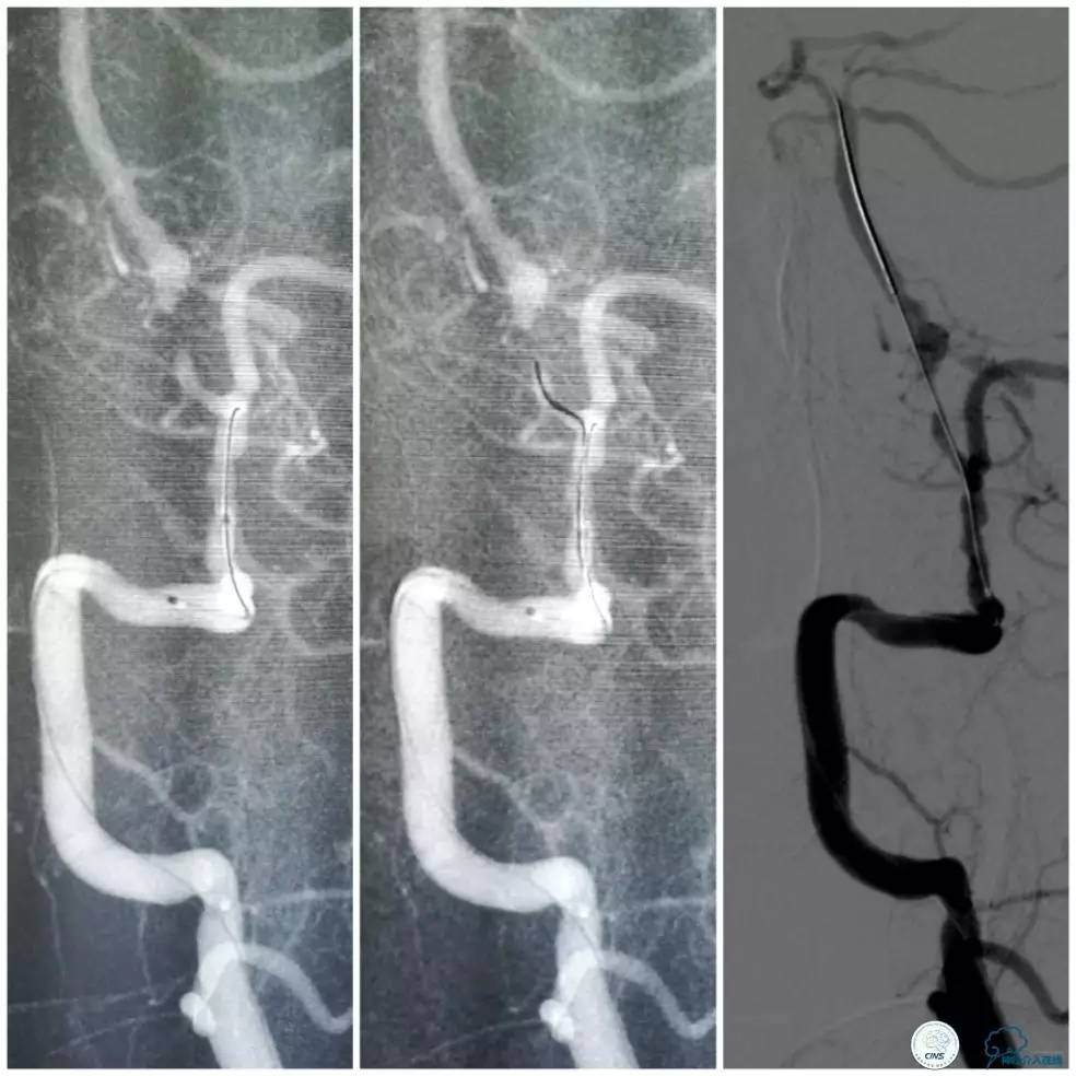天坛周记|右椎动脉V1段及V4-基底动脉串联病变支架治疗一例