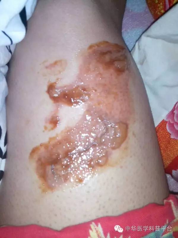 烫伤的紧急处理方法,烫伤紧急处理的第一步是