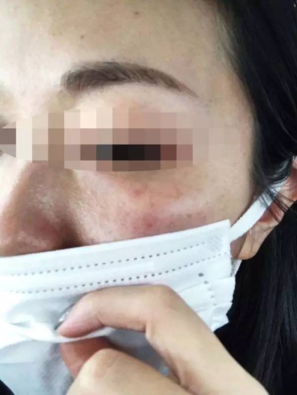 在美容店洗脸过敏怎么维权赔付,美容店洗脸过敏可以赔偿吗