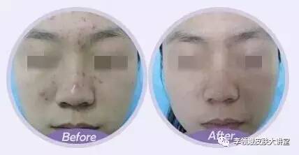 果酸护肤的正确步骤,果酸换肤的正确方法