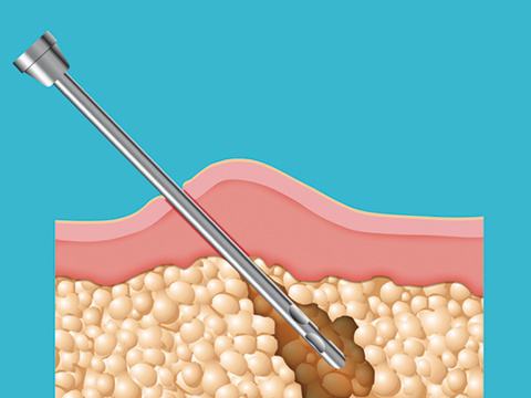 北京协和医院月减10斤的减肥处方,北京协和医院减重处方第二讲