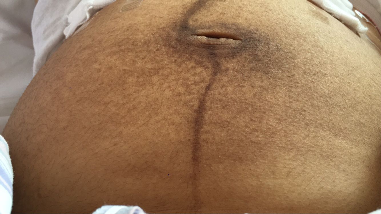 如何消除产后肚子上的赘肉,产后悬浮肚怎么去除