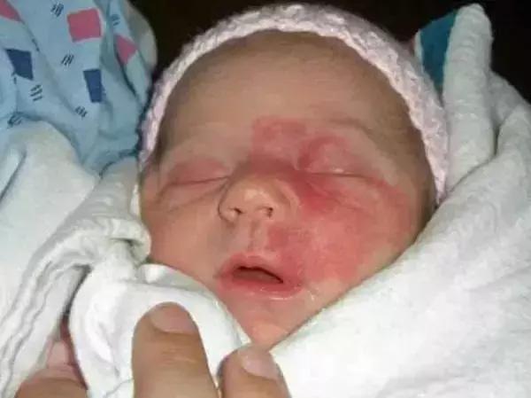 女儿有红胎记，妈妈是这样做的！