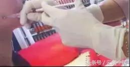 一次就有效的瘦脸方法,黄金微雕瘦脸效果怎么样