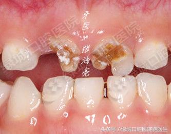 乳前牙透明冠修复大概要多久,乳前牙透明冠操作流程