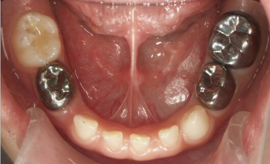 孩子牙齿烂了需要根管治疗吗,孩子牙齿坏了有洞有必要补吗